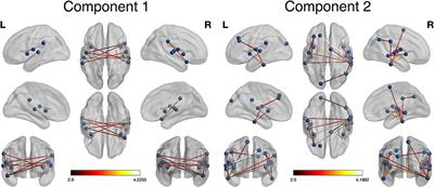 Cross-Sectional Characterization of Local Brain Network Connectivity Pre and Post Breast Cancer Treatment and Distinct Association With Subjective Cognitive and Psychological Function